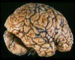 Addicted Brain